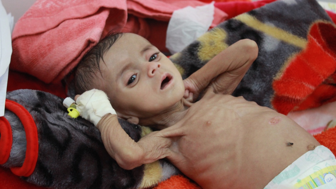 Ein unterernährtes Kind in einer Klinik im Jemen.
