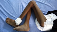 Ein unterernährtes Kind liegt in einem Krankenhaus in Hudaia im Jemen.